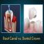 1401-RCT (Per tooth)